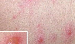 小孩子长水痘可以吃瓜吗,瓜类食物的适宜摄入